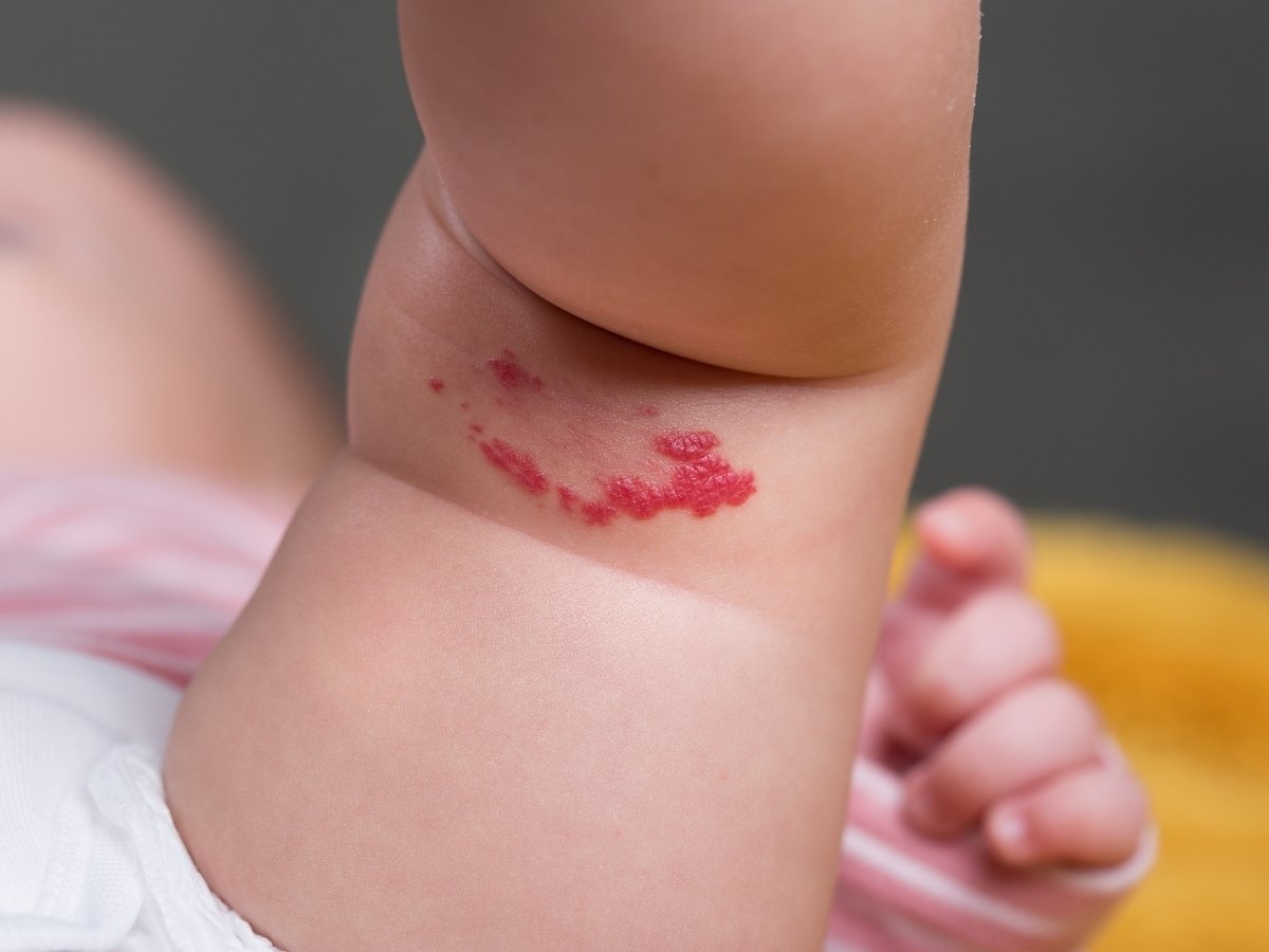 Which Is the Best Treatment For Birthmark Removal