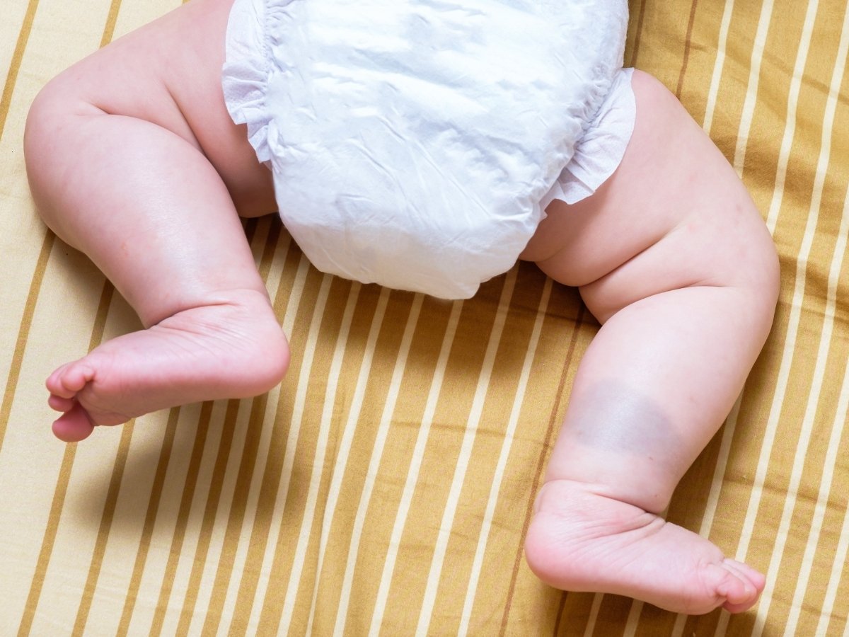 What Parents Should Know About Birthmark Treatment