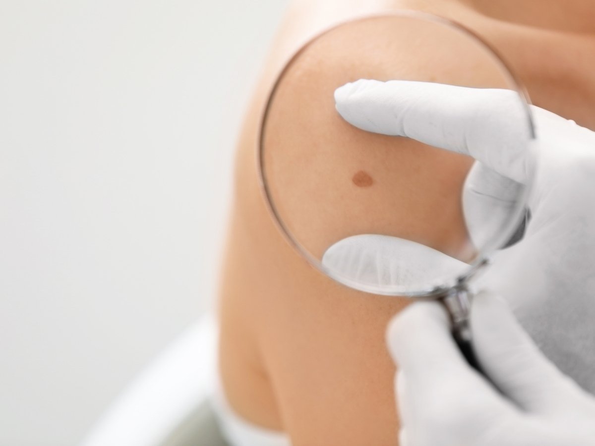 Should You Take Birthmark Removal Treatments